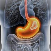 CHIRURGIA ONCOLOGICA